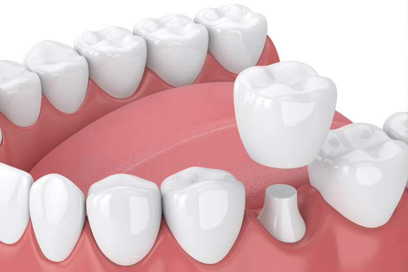 Dental Crowns in Eugene